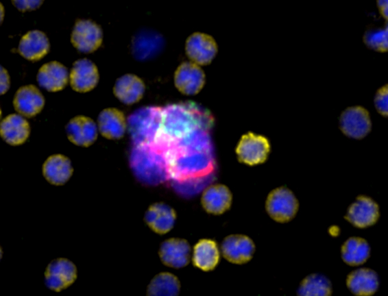 5 cell CTC cluster expressing drug target