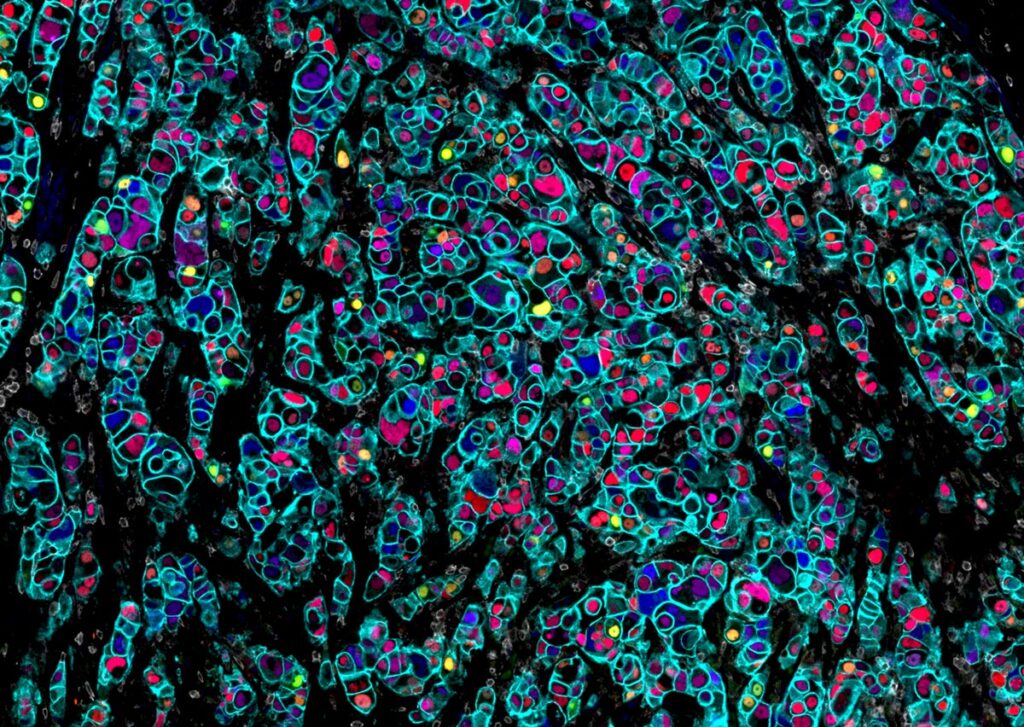 浸潤性乳管癌の多重免疫蛍光画像