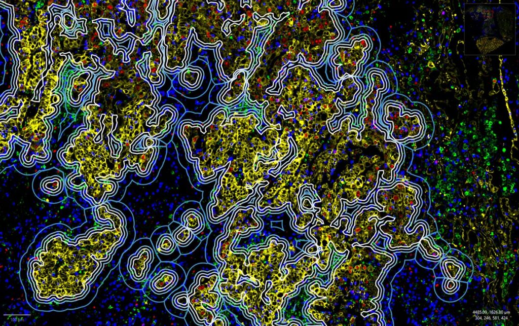 非小細胞肺がんにおける腫瘍微小環境プロファイリング